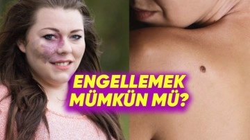 Çilek ve Şarap Lekesi Gibi Lekeler Neden Cildimizde Var?