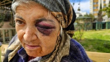 Diyaliz merkezinde dehşet! Zihinsel engeli kadına yumruklu saldırı iddiası