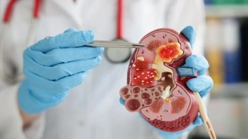 Her 10 kişiden 1’i böbrek taşıyla karşı karşıya