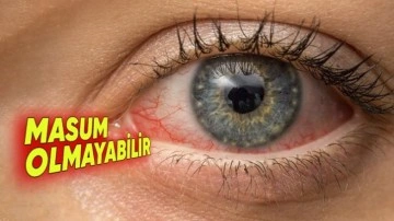 Sabahları Neden Gözlerimiz Kan Çanağı Gibi Oluyor?